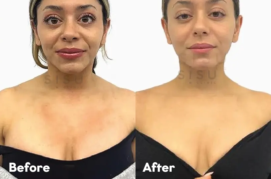 Before and after Trapezius Botox Treatment result