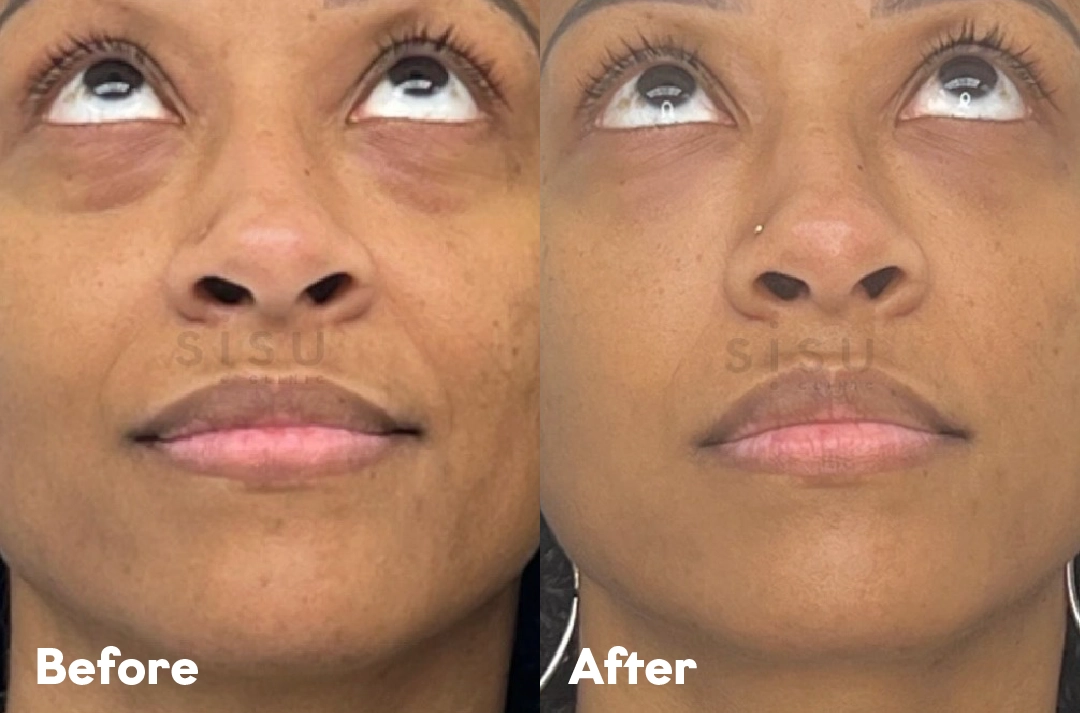 Before and after Under-Eye Filler Treatment result